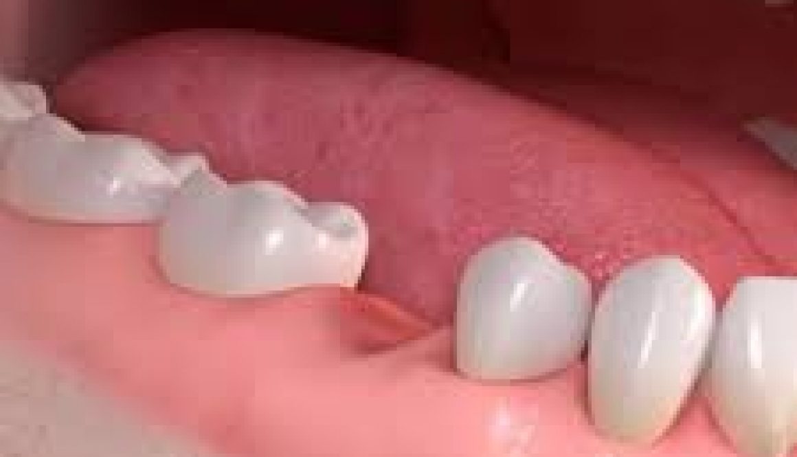 Braki zębowe