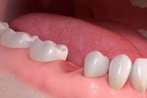Braki zębowe